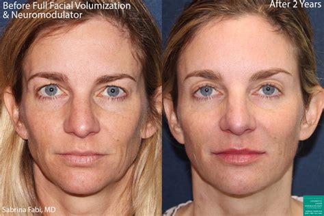 Volume loss in the cheeks leads to flattening, sagging, and drooping, but there is a solution. . Sunken cheek on one side of face